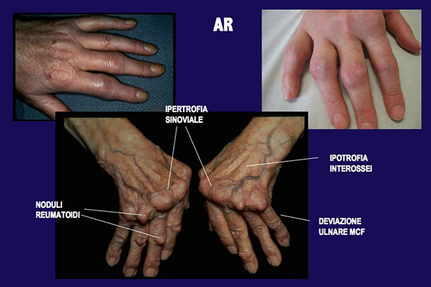 artrite reumatoide